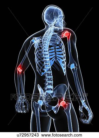 Drawing - Joint pain, conceptual artwork. Fotosearch