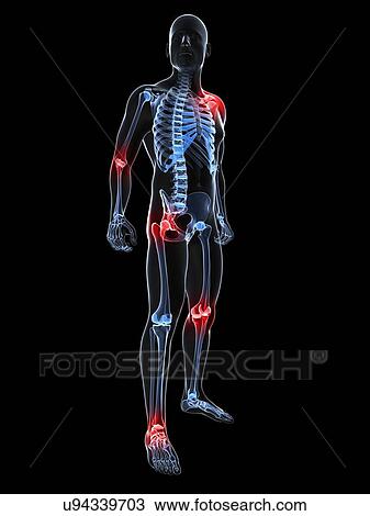 Joint pain, conceptual artwork View Large Illustration Drawing - Joint pain, conceptual artwork. Fotosearch