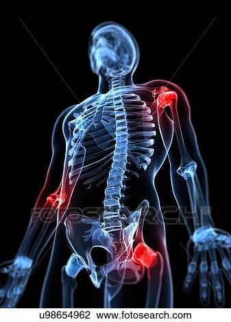 Drawing - Joint pain, conceptual artwork. Fotosearch