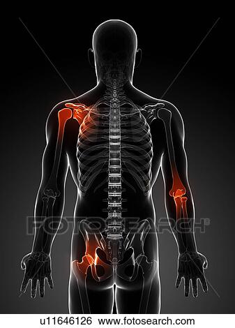 Joint pain, conceptual artwork View Large Illustration Stock Illustration - Joint pain, conceptual artwork. Fotosearch