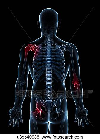 Stock Illustration - Joint pain, conceptual artwork. Fotosearch