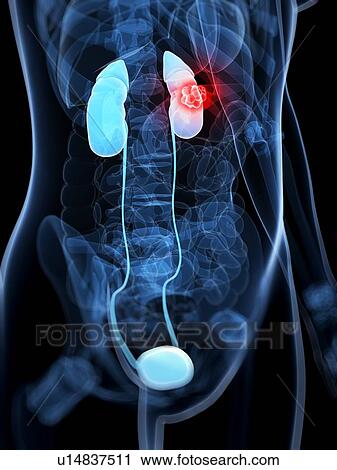 Kidney cancer, artwork View Large Illustration Clip Art - Kidney cancer, artwork. Fotosearch