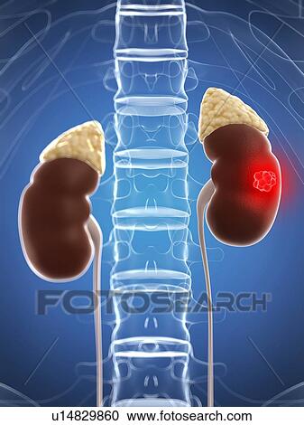 Kidney cancer, artwork View Large Illustration Clipart - Kidney cancer, artwork. Fotosearch