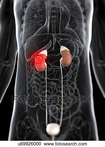 Clipart - Kidney cancer, artwork. Fotosearch