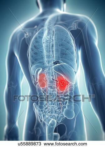 Kidney cancer, artwork View Large Illustration Drawing - Kidney cancer, artwork. Fotosearch
