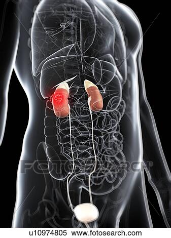 Kidney cancer, artwork View Large Illustration Stock Illustration - Kidney cancer, artwork. Fotosearch