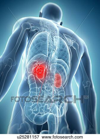 Kidney cancer, artwork View Large Illustration Stock Illustration - Kidney cancer, artwork. Fotosearch