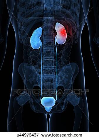 Kidney cancer, artwork View Large Illustration Stock Illustration - Kidney cancer, artwork. Fotosearch