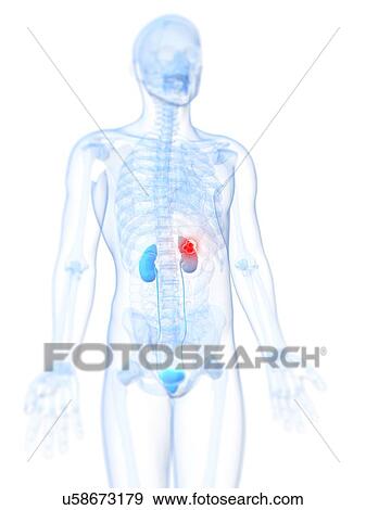 Stock Illustration - Kidney cancer, artwork. Fotosearch