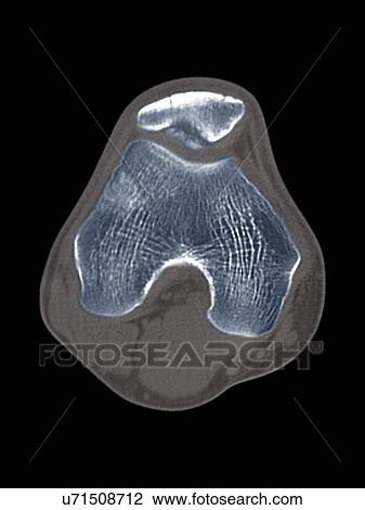 Drawing - Knee disease, CT scan. Fotosearch