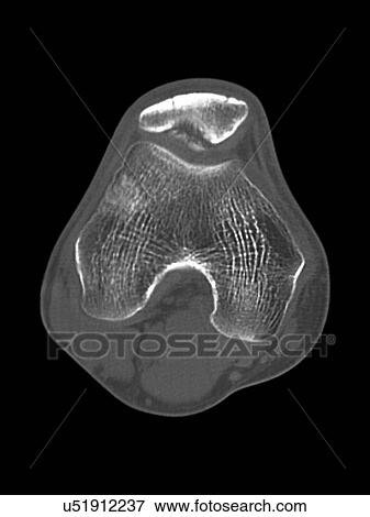 Stock Illustration - Knee disease, CT scan. Fotosearch