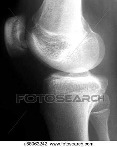 Knee disease, X-ray View Large Illustration Drawing - Knee disease, X-ray. Fotosearch