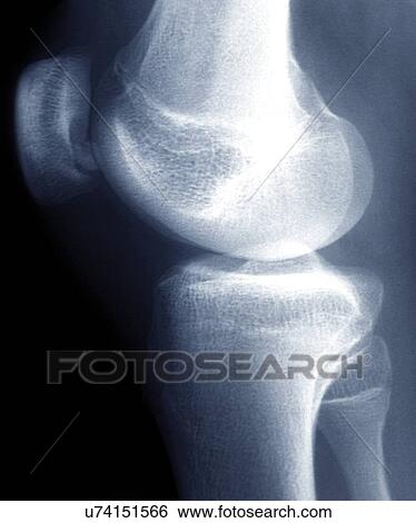 Stock Illustration - Knee disease, X-ray. Fotosearch