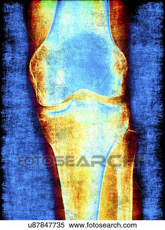 Knee joint, x-ray, artwork View Large Illustration Stock Illustration - Knee joint, x-ray, artwork. Fotosearch