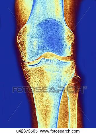 Knee joint, x-ray View Large Illustration Stock Illustration - Knee joint, x-ray. Fotosearch
