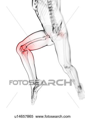 Stock Illustration - Knee pain, conceptual artwork. Fotosearch