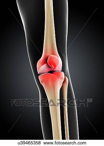 Stock Illustration - Knee pain, conceptual artwork. Fotosearch