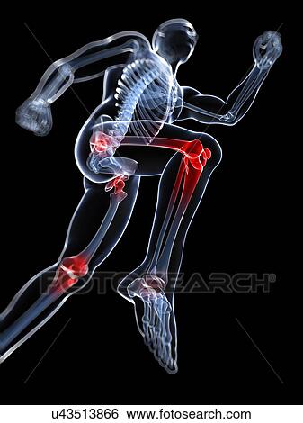 Stock Illustration - Knee pain, conceptual artwork. Fotosearch