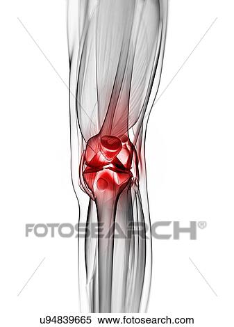 Stock Illustration - Knee pain, conceptual artwork. Fotosearch