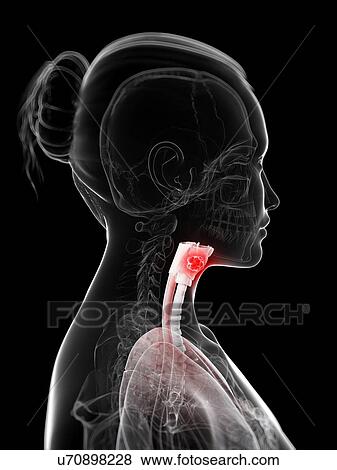 Larynx cancer, artwork View Large Illustration Stock Illustration - Larynx cancer, artwork. Fotosearch