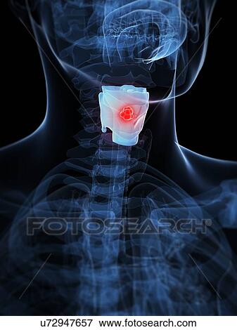 Larynx cancer, artwork View Large Illustration Stock Illustration - Larynx cancer, artwork. Fotosearch