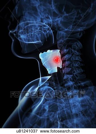 Larynx cancer, artwork View Large Illustration Stock Illustration - Larynx cancer, artwork. Fotosearch