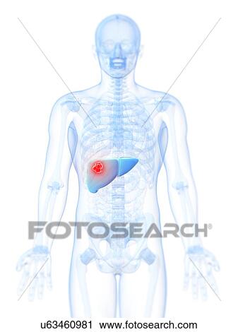 Liver cancer, artwork View Large Illustration Clip Art - Liver cancer, artwork. Fotosearch