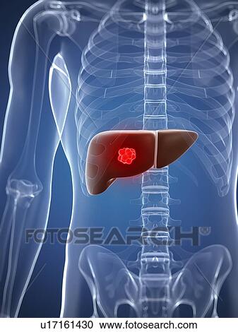 Liver cancer, artwork View Large Illustration Clipart - Liver cancer, artwork. Fotosearch