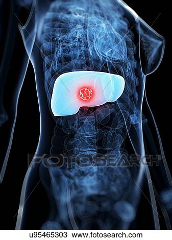 Liver cancer, artwork View Large Illustration Drawing - Liver cancer, artwork. Fotosearch