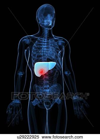 Stock Illustration - Liver cancer, artwork. Fotosearch