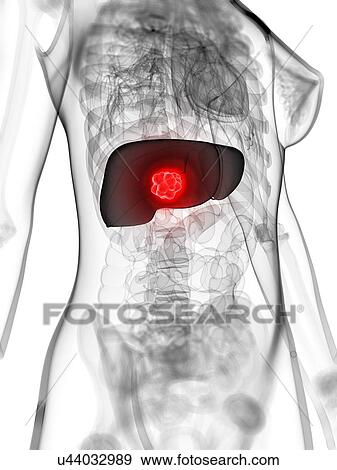 Liver cancer, artwork View Large Illustration Stock Illustration - Liver cancer, artwork. Fotosearch