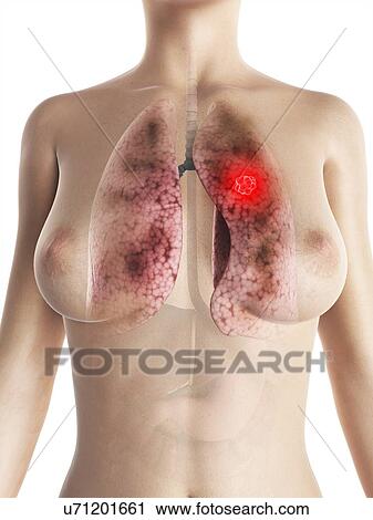 Lung cancer, artwork View Large Illustration Clip Art - Lung cancer, artwork. Fotosearch