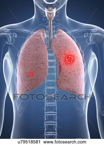 Clip Art - Lung cancer, artwork. Fotosearch