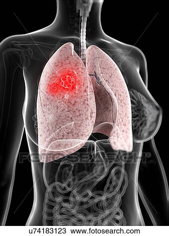 Lung cancer, artwork View Large Illustration Drawing - Lung cancer, artwork. Fotosearch