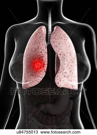 Drawing - Lung cancer, artwork. Fotosearch