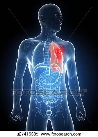 Lung cancer, artwork View Large Illustration Stock Illustration - Lung cancer, artwork. Fotosearch