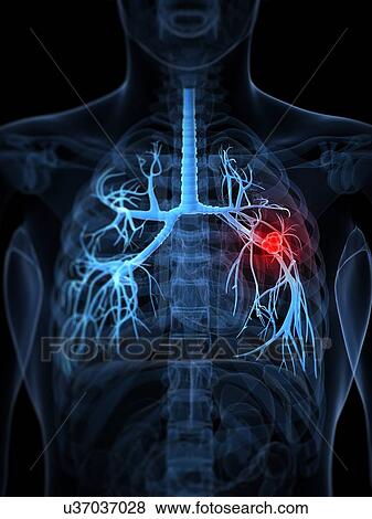Lung cancer, artwork View Large Illustration Stock Illustration - Lung cancer, artwork. Fotosearch