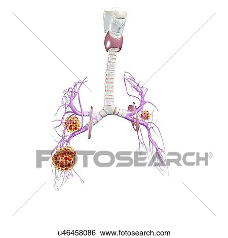 Lung cancer, artwork View Large Illustration Stock Illustration - Lung cancer, artwork. Fotosearch