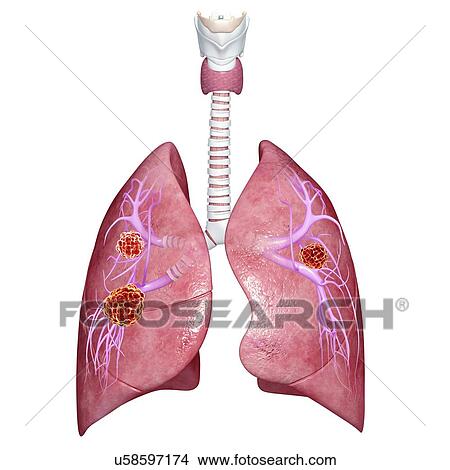 Lung cancer, artwork View Large Illustration Stock Illustration - Lung cancer, artwork. Fotosearch