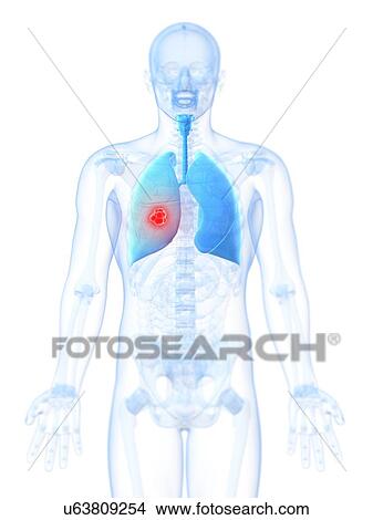 Lung cancer, artwork View Large Illustration Stock Illustration - Lung cancer, artwork. Fotosearch