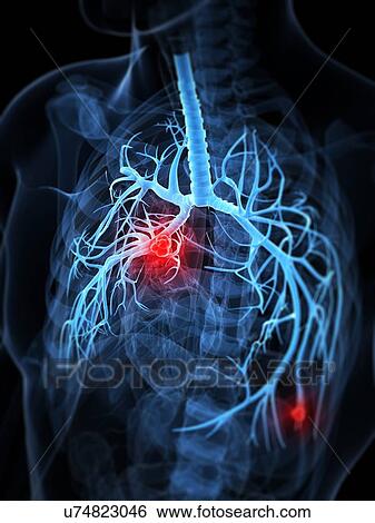 Lung cancer, artwork View Large Illustration Stock Illustration - Lung cancer, artwork. Fotosearch