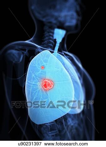 Lung cancer, artwork View Large Illustration Stock Illustration - Lung cancer, artwork. Fotosearch