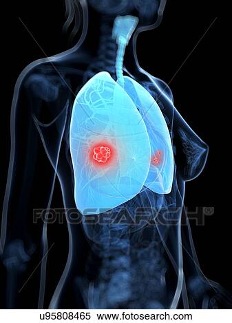 Stock Illustration - Lung cancer, artwork. Fotosearch