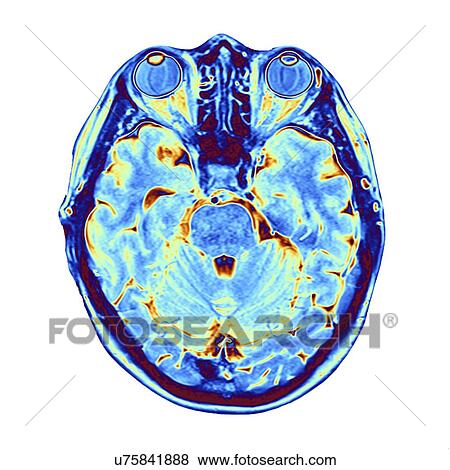 Stock Illustration - MRI brain scan. Fotosearch