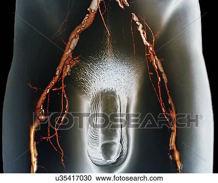 Narrowed arteries, 3D CT scan View Large Illustration Clipart - Narrowed arteries, 3D CT scan. Fotosearch