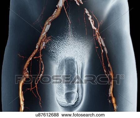 Narrowed arteries, 3D CT scan View Large Illustration Stock Illustration - Narrowed arteries, 3D CT scan. Fotosearch