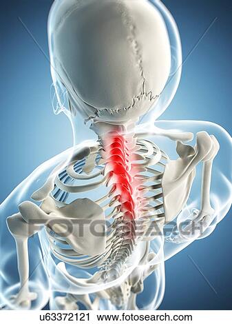 Neck pain, conceptual artwork View Large Illustration Clip Art - Neck pain, conceptual artwork. Fotosearch