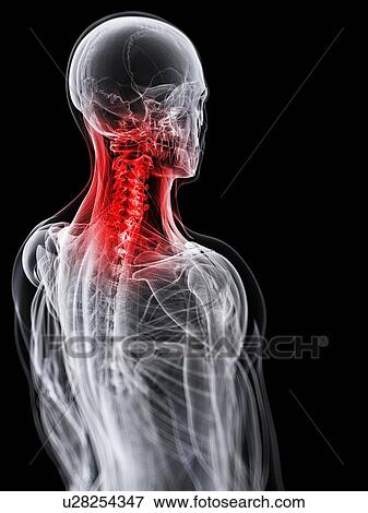 Neck pain, conceptual artwork View Large Illustration Stock Illustration - Neck pain, conceptual artwork. Fotosearch