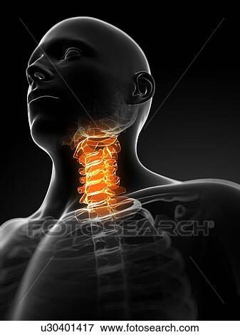 Stock Illustration - Neck pain, conceptual artwork. Fotosearch