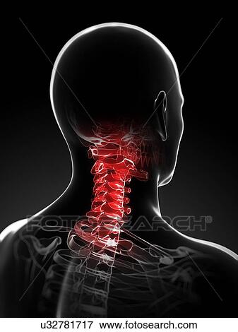 Neck pain, conceptual artwork View Large Illustration Stock Illustration - Neck pain, conceptual artwork. Fotosearch